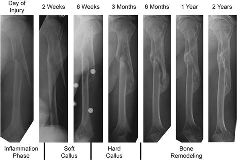 Fractures and Bone Healing