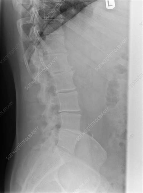 Osteoarthritis of the spine, X-ray - Stock Image - C002/9621 - Science ...