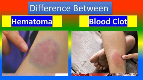 Contusion Vs Hematoma