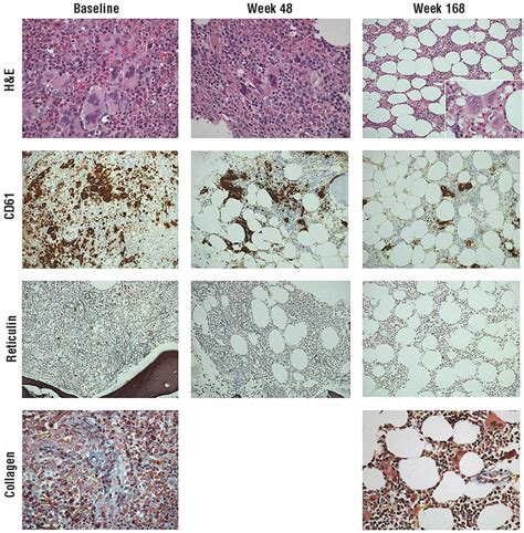 Resolution of bone marrow fibrosis in a patient receiving JAK1/JAK2 ...