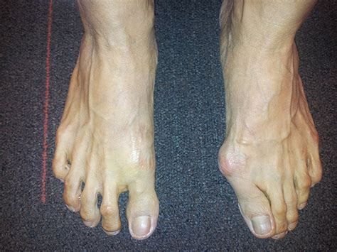 Foot Deformity Singapore | Surgery Reconstruction | Treatment