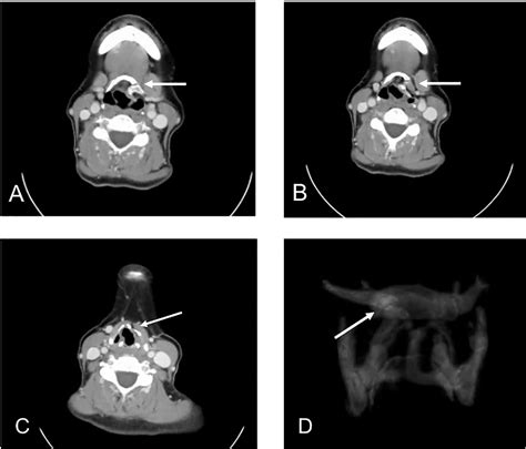 Figure 2 from A complex fracture of the hyoid bone and the larynx after ...