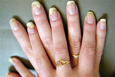 7 Symptoms To Spot The Nail Fungus Before it Harms