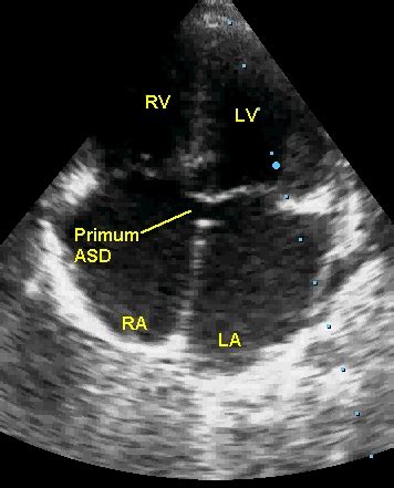 Echocardiogram in ostium primum ASD with tricuspid regurgitation – with ...