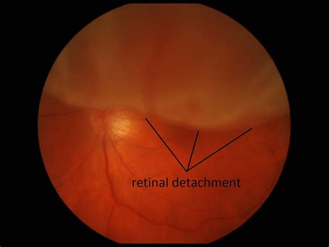 Retinal Detachment Treatment in Elmhurst, IL | Skowron Eye Care