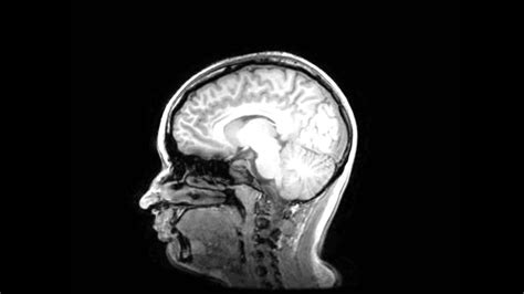 My Brain - MRI Scan Result Images - YouTube