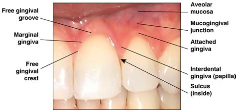 Papillary Gingiva