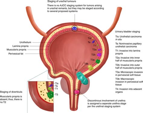 Staging of bladder cancer - Magers - 2019 - Histopathology - Wiley ...