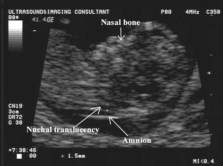 Normal Values for the Nuchal Translucency and Technique for Measurement