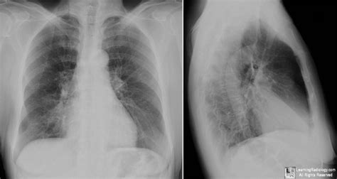 LearningRadiology - right, middle, lobe, syndrome, rml, atelectasis ...