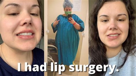 Lip Surgery & Healing Process | Mucocele Removal - YouTube