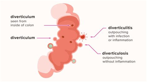 O le a le lagona o se osofaʻiga o le diverticulitis? Fa'ailoga ma ...