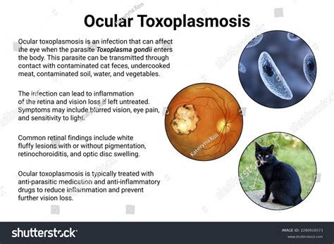 Ocular Toxoplasmosis Disease Caused By Singlecelled Stock Illustration ...