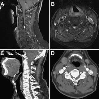 Repeated MRI with contrast in a T1 series (A and B) showed a ...