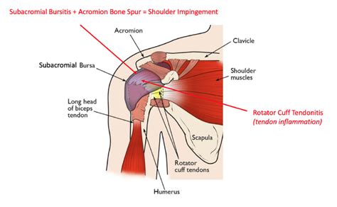 Subacromial Bursitis | Shoulder Procedures | Sydney Shoulder Unit