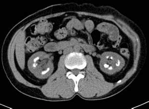 Medullary nephrocalcinosis – Radiology Cases