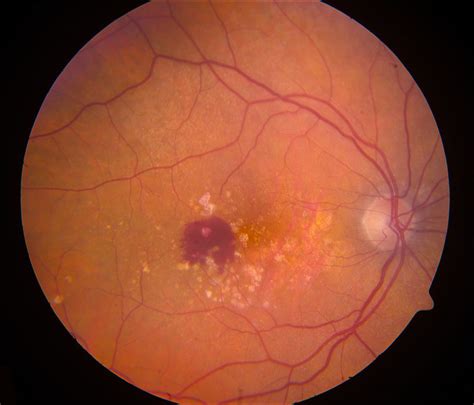 Retinal-scan analysis can predict advance of macular degeneration ...