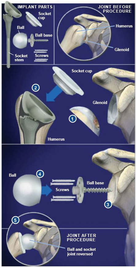 Reverse Total Shoulder Replacement | Central Coast Orthopedic Medical Group