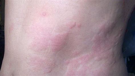 Chronic Hives (Chronic Idiopathic Urticaria): Causes & Treatment