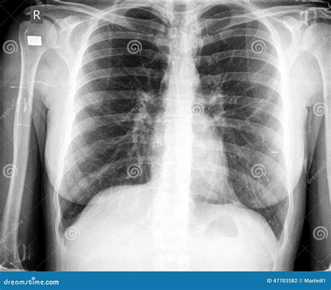 Acute Bronchitis Chest X Ray