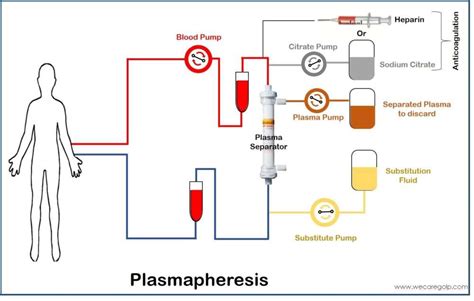 Plasmapheresis - We Care