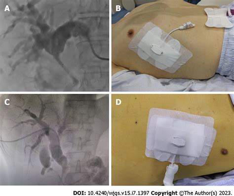 Eusguided Biliary Drainage For Patients With Malignant