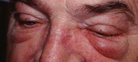 Polymyositis - Causes, Symptoms, Prognosis, Diagnosis, Treatment