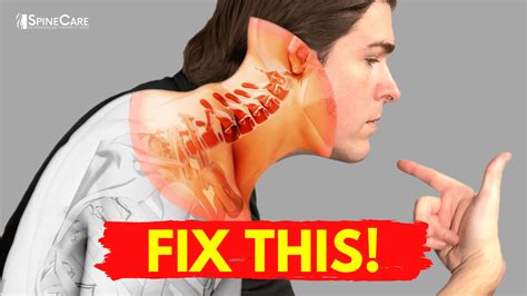 Best Ways to Get Neck Bulging Disc Pain Relief AT HOME | SpineCare