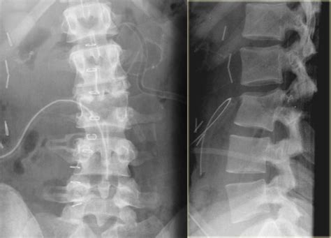 The Radiology Assistant : Spine - Thoracolumbar injury