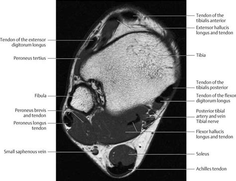 Mri Plantar Foot Anatomy Muscles