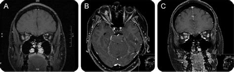 MRI in optic perineuritis | Download Scientific Diagram