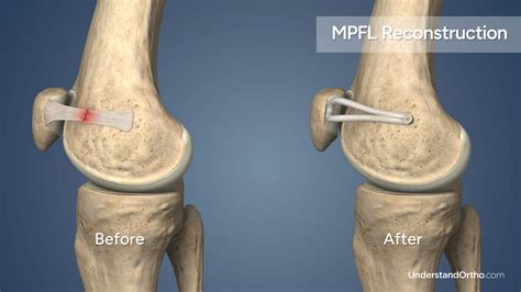 MPFL Reconstruction – UnderstandOrtho™