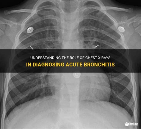 Understanding The Role Of Chest X-Rays In Diagnosing Acute Bronchitis ...