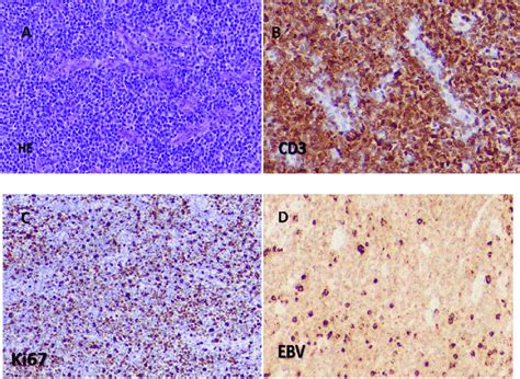 Specimen detail of supraclavicular lymph node biopsy. A.... | Download ...