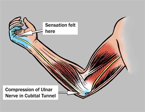 Cubital Tunnel Syndrome: Causes, Symptoms, Diagnosis & Treatment » How ...