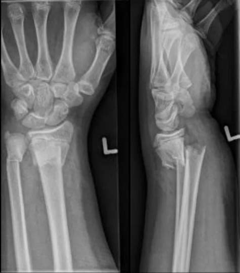 Colle Fracture - Distal Radial Fracture | Radiology Case | - RadioGyan