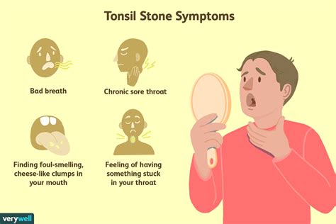 What Are Tonsil Stones? Symptoms, Causes, and Removal