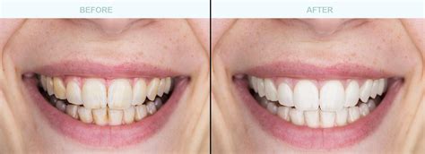 Teeth Cleaning Before And After