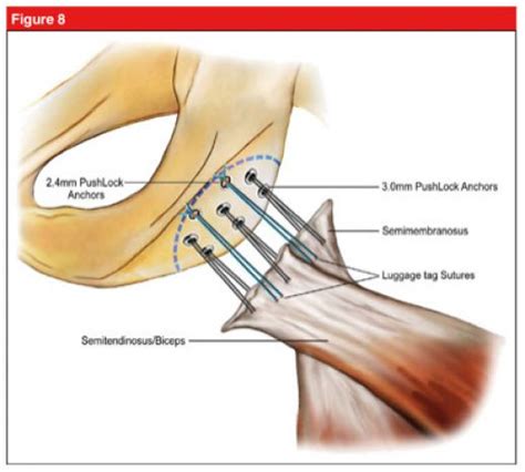 Boston Sports | prp, PRP, platelet rich plasma, platelet injection,…