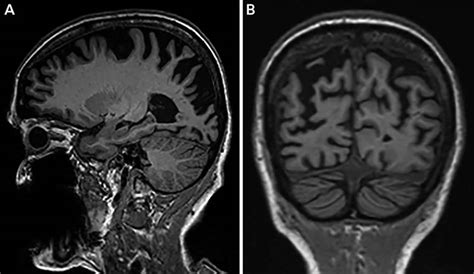 Posterior cortical atrophy causes, symptoms, diagnosis, treatment ...