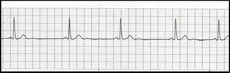 EKG Rhythm Strip Quiz 108