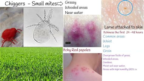 Chiggers bite - red bugs, harvest mites, symptoms and treatment. - YouTube