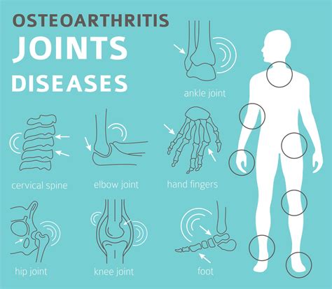 OSTEOARTHRITIS AND SSD BENEFITS - Cannon Disability Law