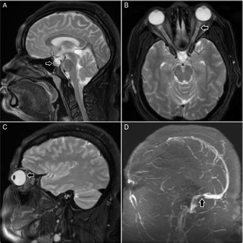 Brain and orbits MRI (A-C). Sagittal T2 (A) shows partial empty sella ...