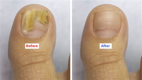 Dermatologists Explain the Cause of Nail Fungus (and How to Fix It)