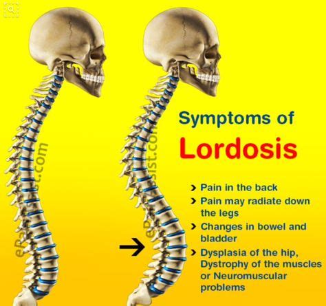 Pin by Dawn Dalton on Back | Scoliosis, Lumbar lordosis, Scoliosis ...