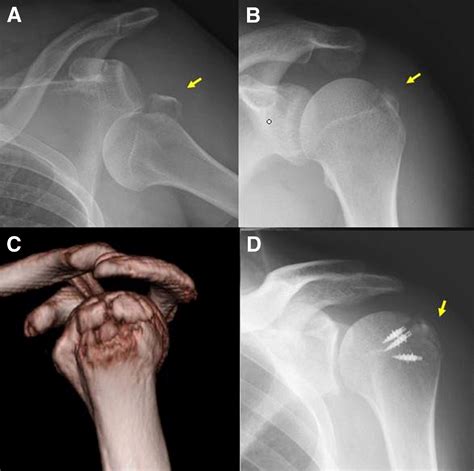 Arthroscopic Fixation Technique for Comminuted, Displaced Greater ...