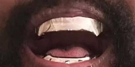 Doctor Warns Kanye West About His Titanium Teeth, Makes a Concerning ...