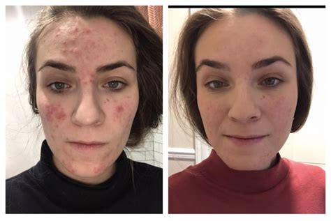 One week on Azelaic Acid : r/Rosacea