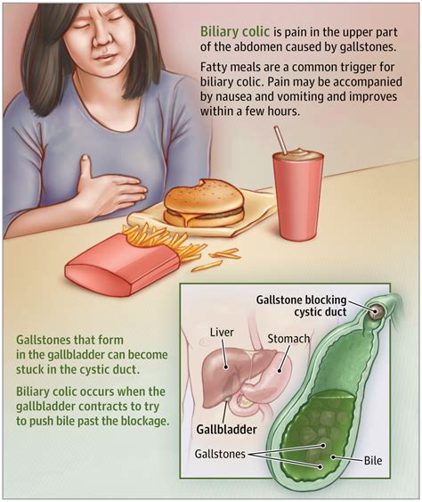 This JAMA Patient Page describes the symptoms, diagnosis, and treatment ...